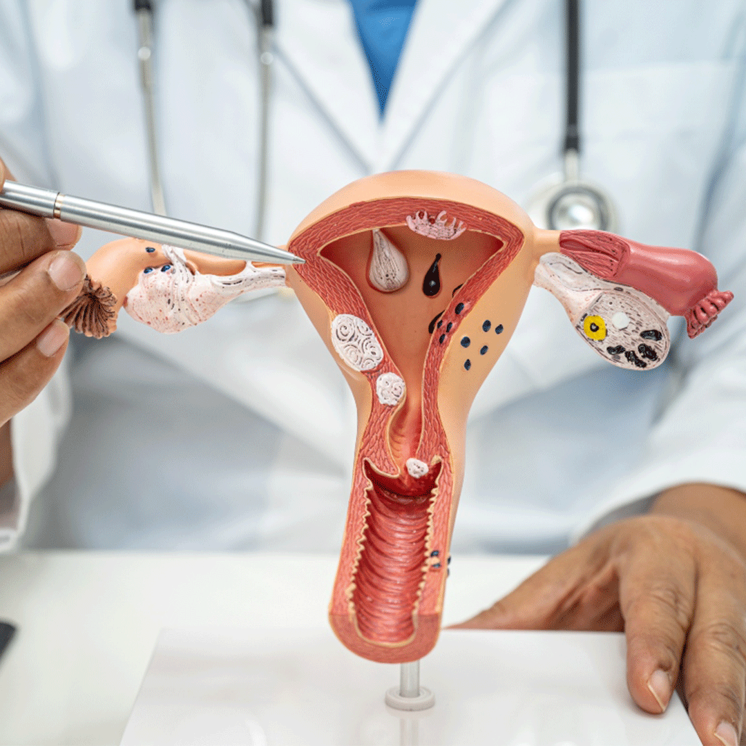 Fibroid Treatment in Jamaica